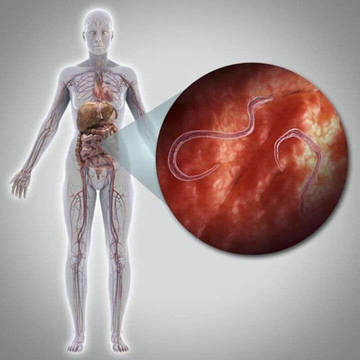 Parasiten am Kierper vun enger Persoun